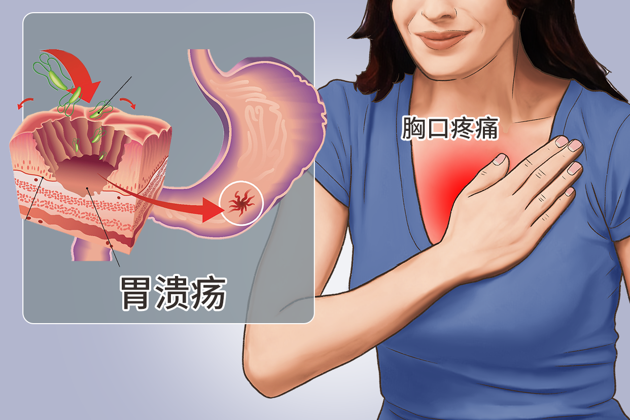 胃溃疡胸口疼位置图 胃溃疡感觉胸前不舒服