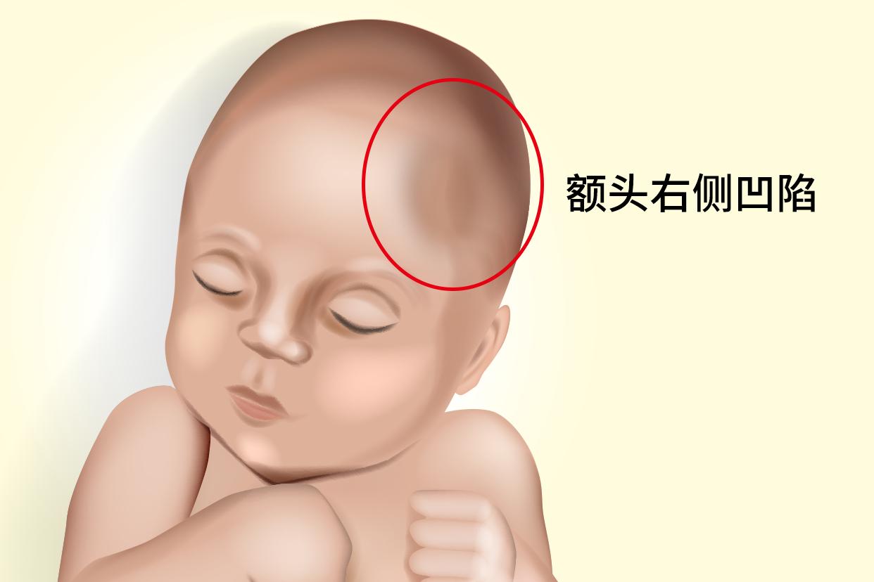 宝宝额头右侧凹陷图片