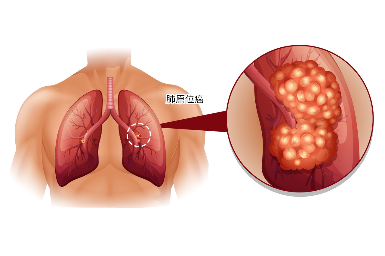 肺原位癌图