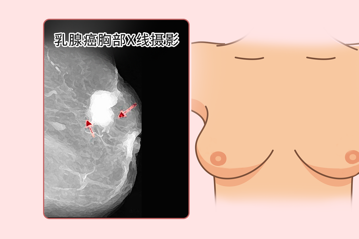 乳腺癌照片能检查出来吗