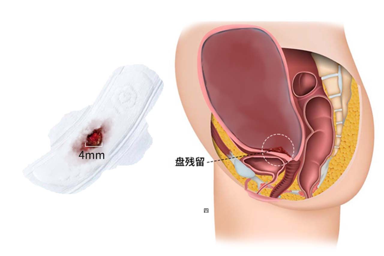 排出的残留物4mm的图片