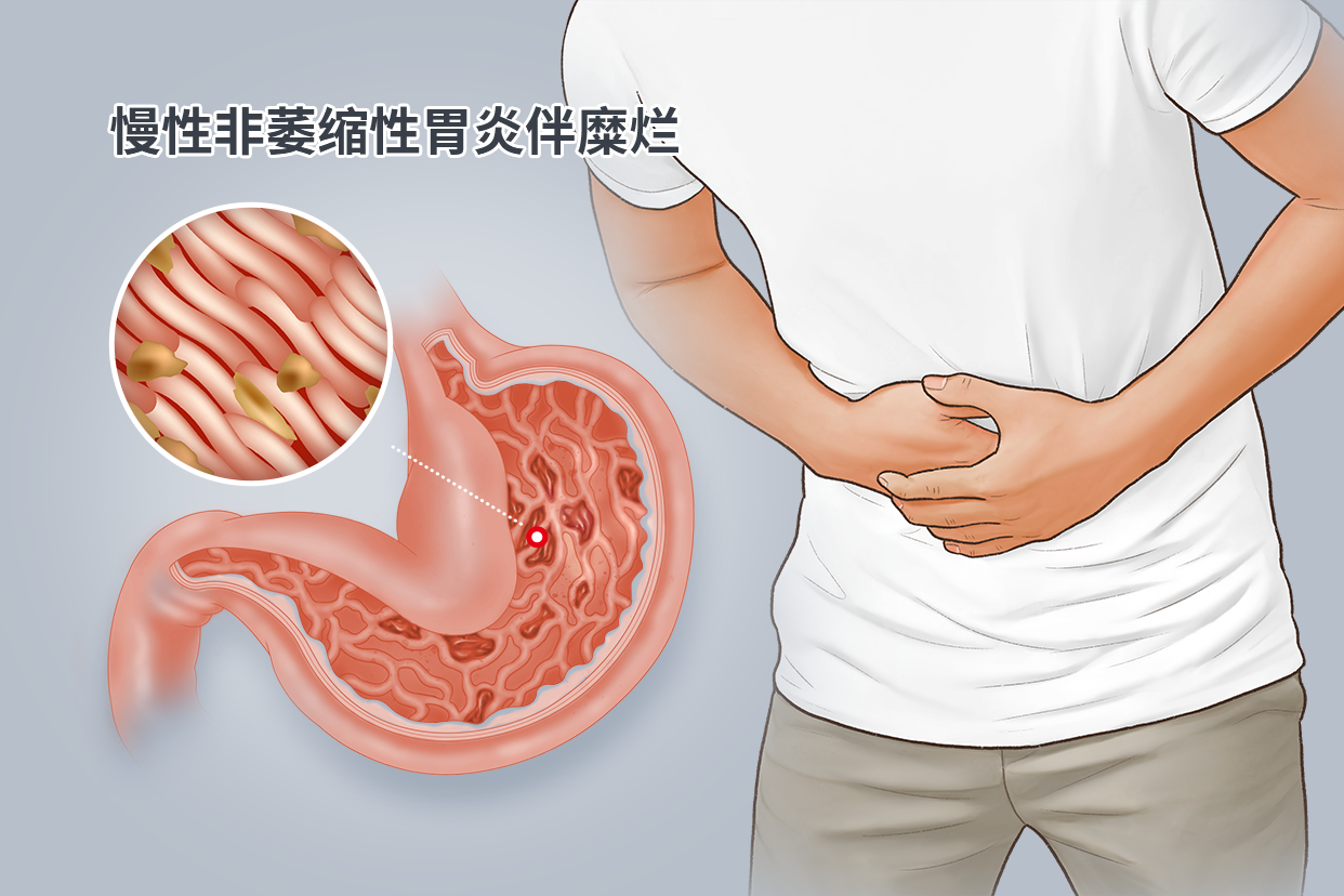 慢性非萎缩性胃炎伴糜烂图片