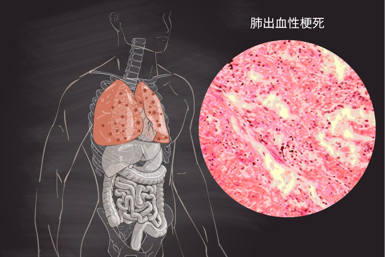 肺出血性梗死图片手绘图