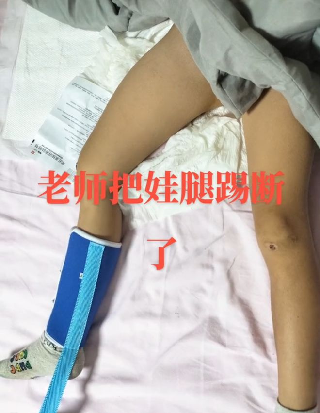 学生因没按时午休被老师踢断腿骨 教育局：正在跟进处理