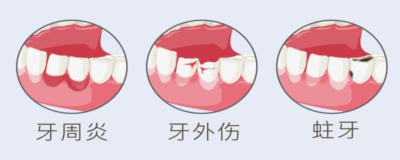 种牙大概多少钱一颗