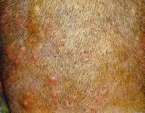 头皮上长痘痘是什么原因（额头和头皮上长痘痘是什么原因）