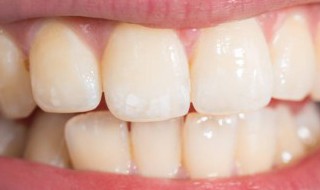 牙石是什么 牙石是什么原因造成的