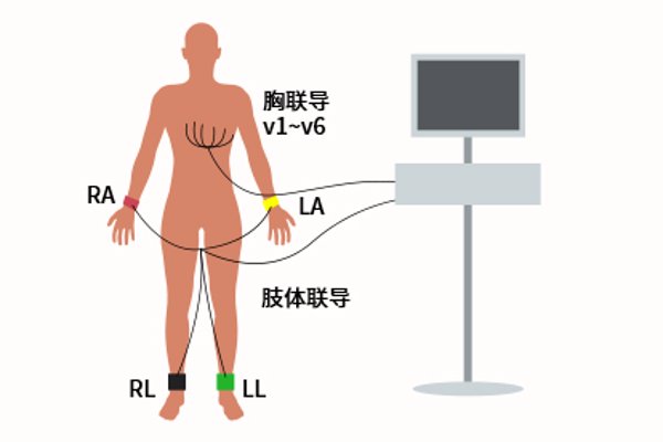 心电图四肢位置图片（心电图肢体位置图片 位置图）