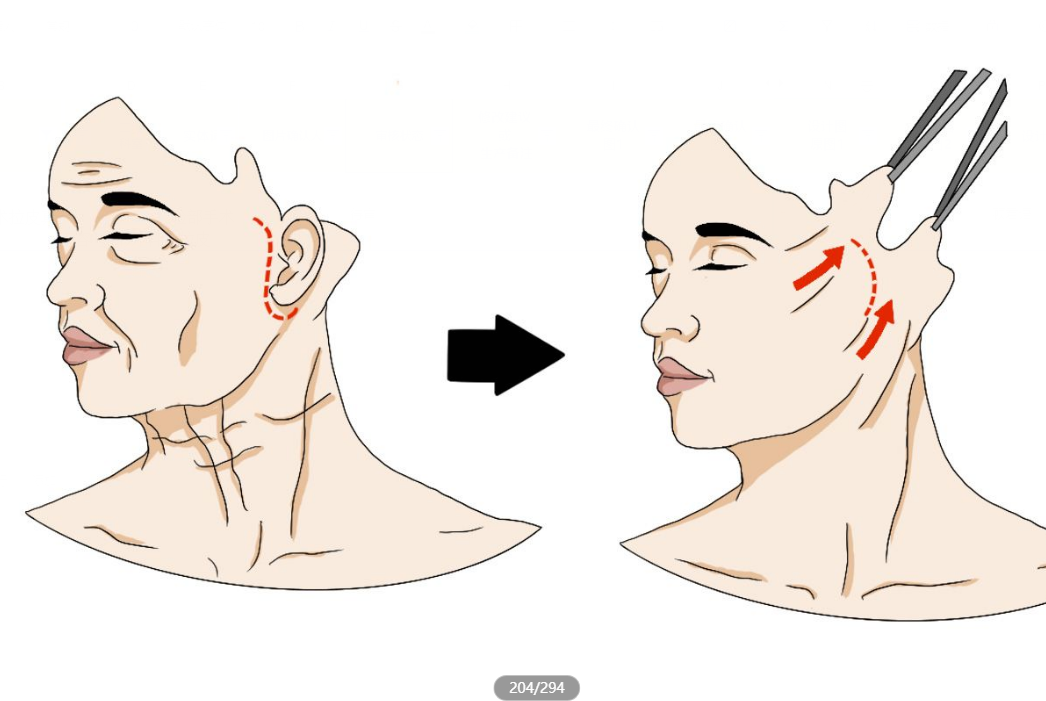 脸部拉皮手术图片 脸部拉皮手术图片真实