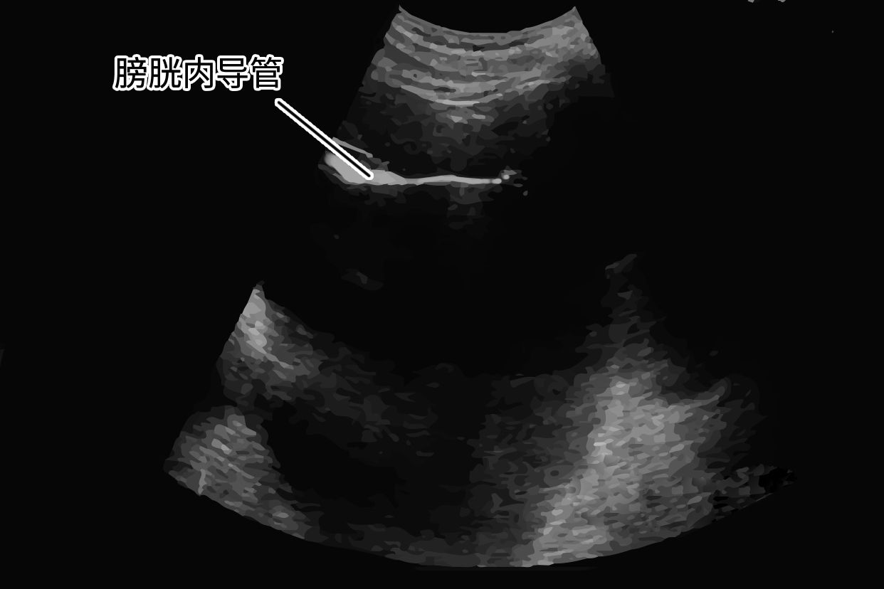膀胱内导尿管b超图片