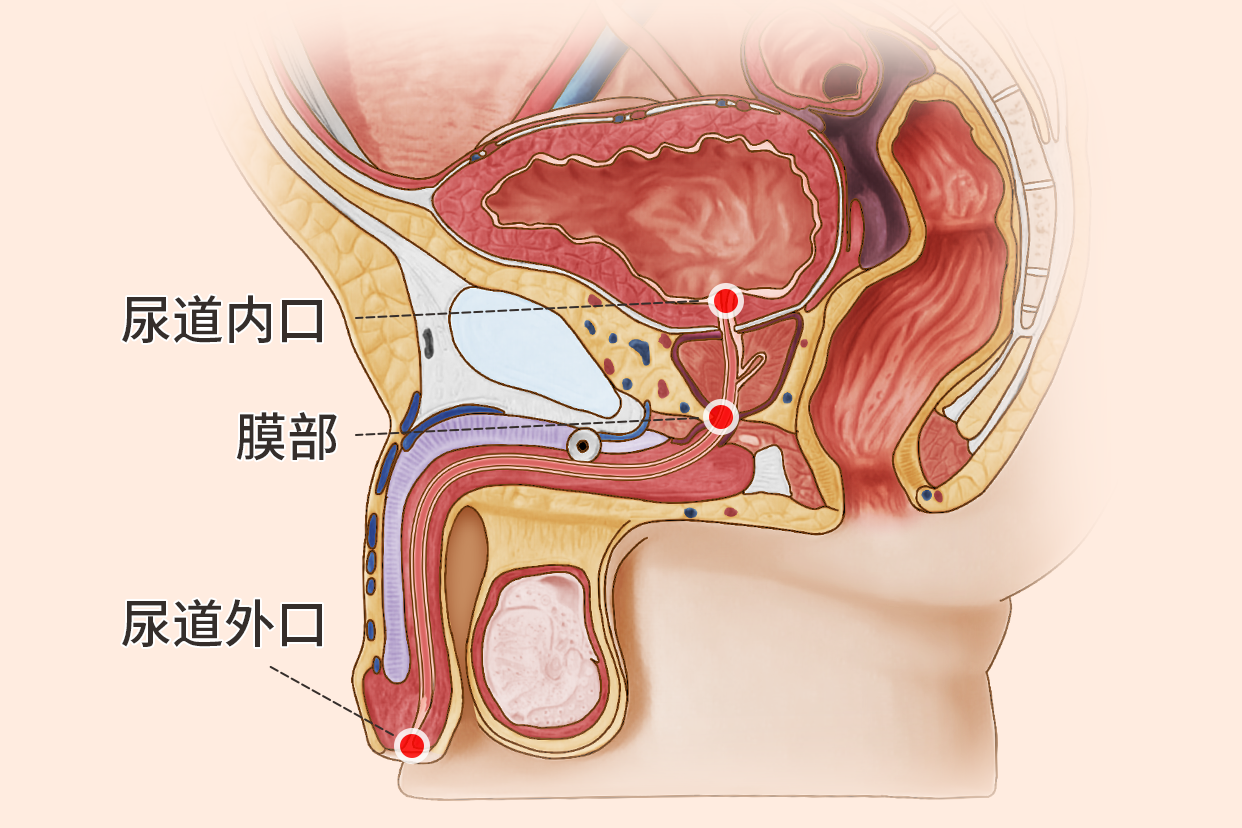 尿道狭窄图片