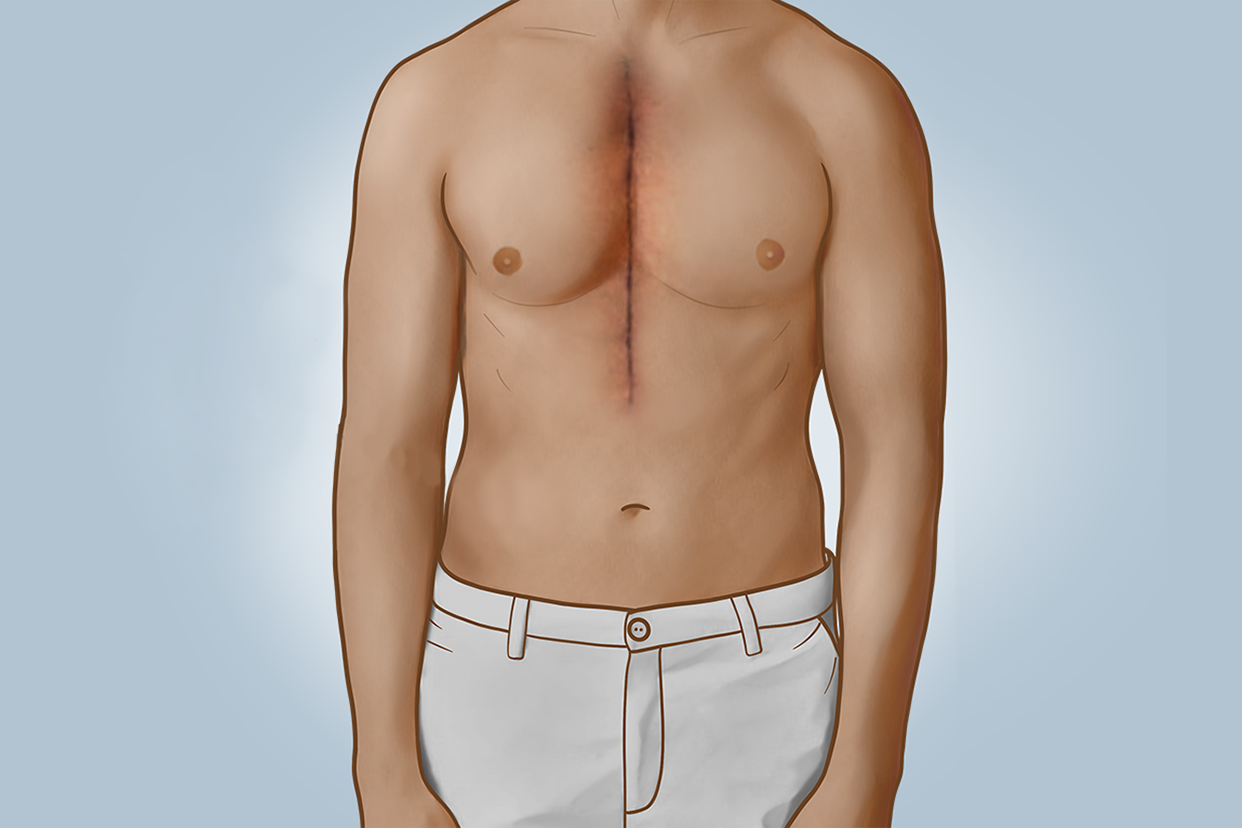 开胸手术拆线后伤口图片 开胸手术拆线后伤口图片真实