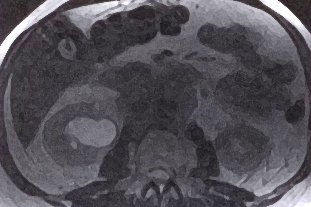 腹膜后纤维化ct图片 后腹膜纤维化CT