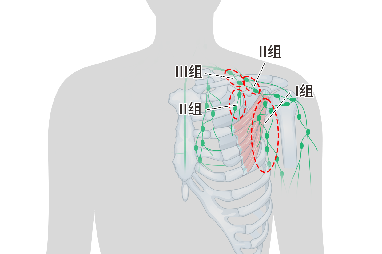 中央区淋巴结图片 中央区淋巴结和颈部淋巴结