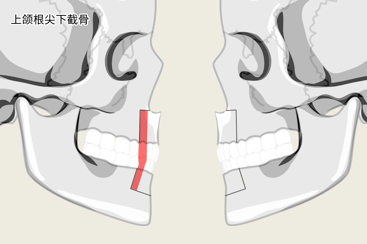 上颌根尖下截骨示意图 上下颌根尖下截骨