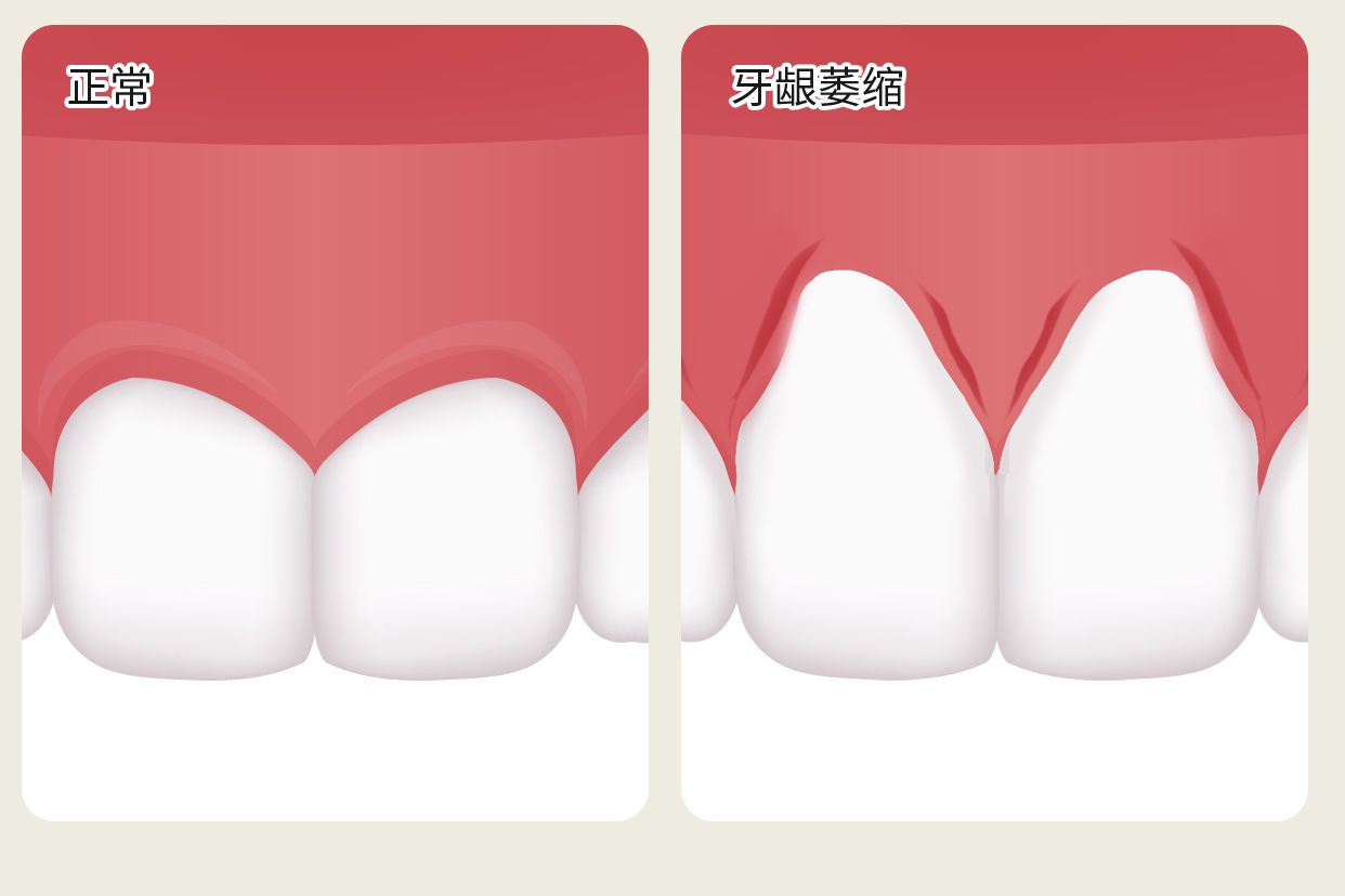 正常没萎缩的牙龈图片 正常的牙龈和萎缩对比