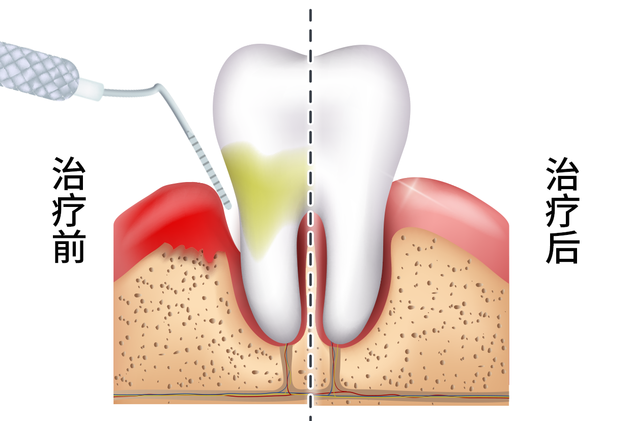 牙周炎牙缝修补效果图 牙周炎牙缝大怎么修复最好