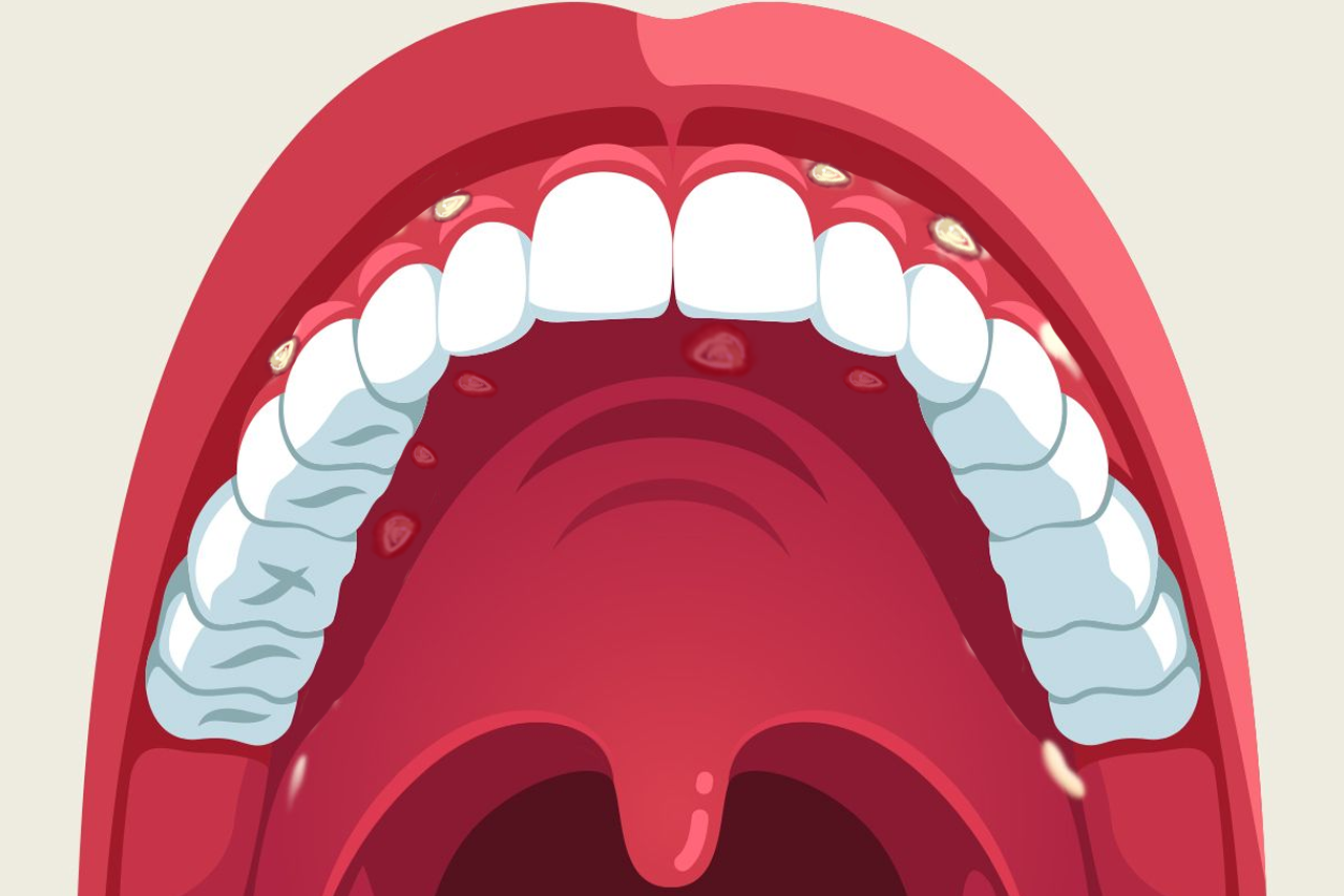 牙龈两侧溃疡图片 牙龈两侧溃疡图片真实