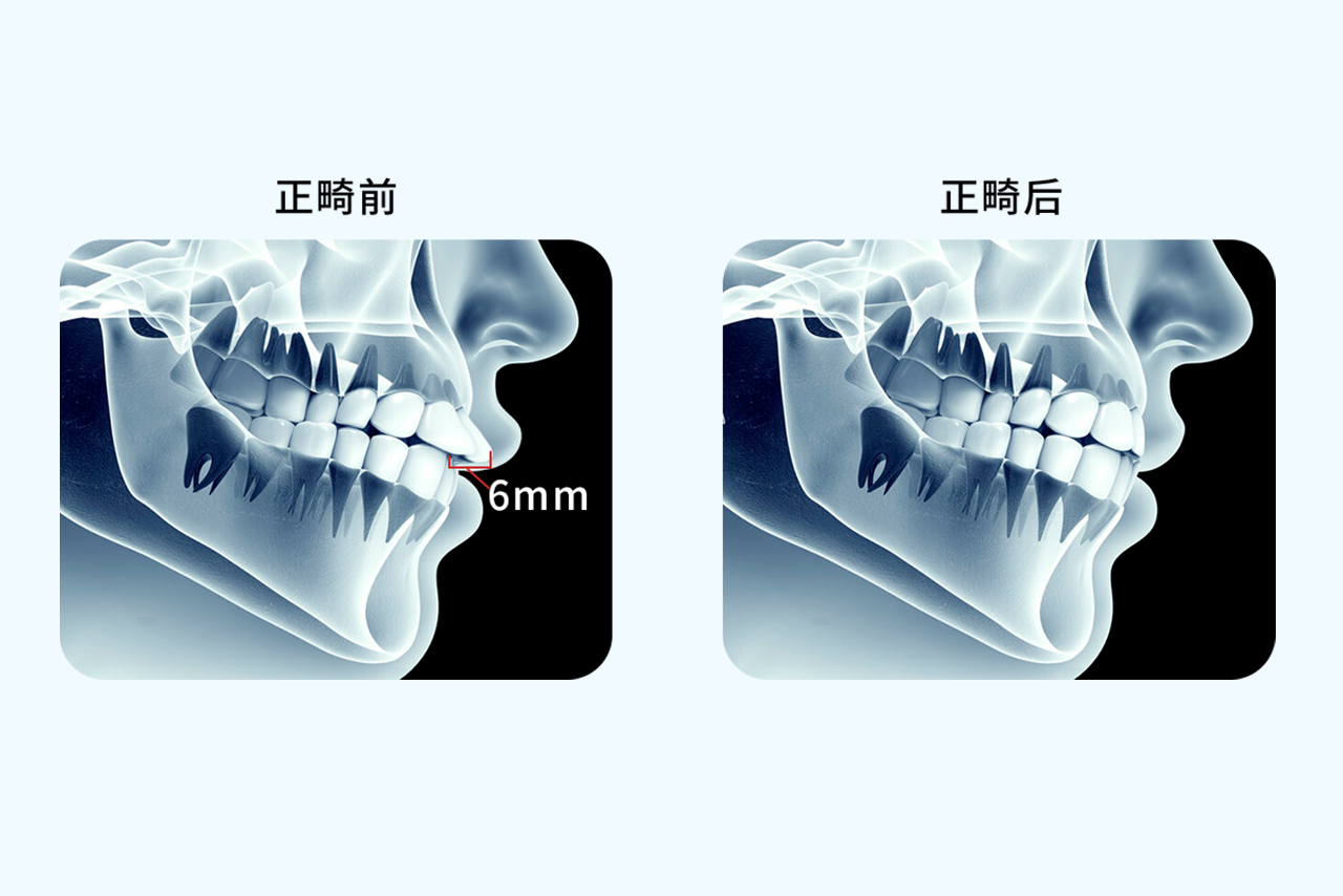 正畸内收6mm效果图（正畸内收5mm对比）