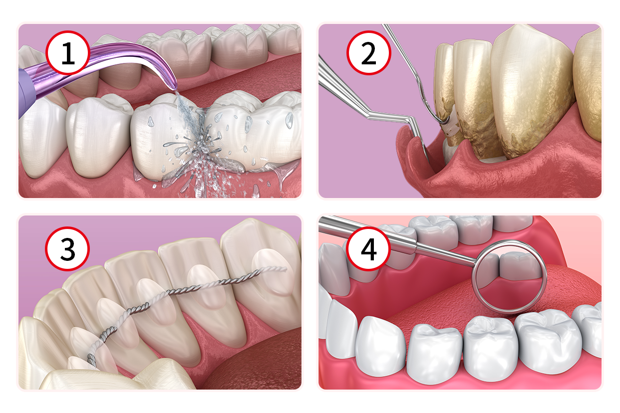 牙周治疗四个步骤图解 牙周的治疗方法