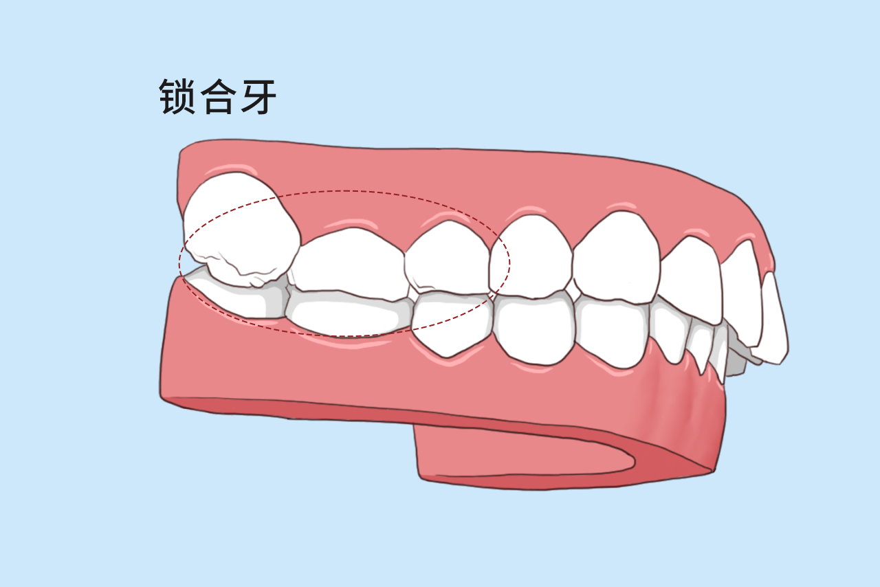 锁合牙图片 牙齿锁合图片