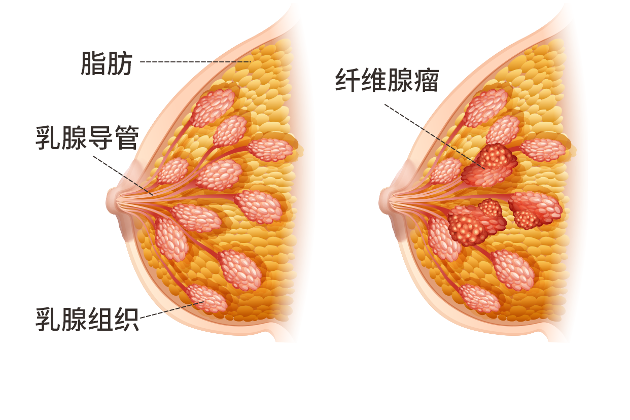 乳房上方纤维瘤图片（乳房上方纤维瘤图片大全）