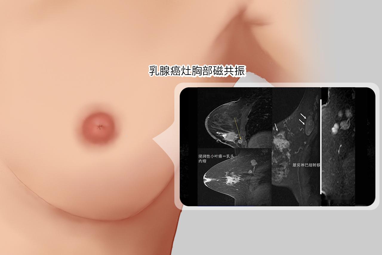 乳腺癌灶胸部磁共振图片（乳腺癌灶胸部磁共振图片大全）