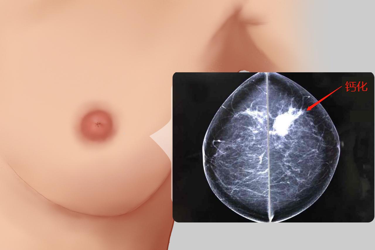 乳腺癌钙化图片（乳腺癌钙化图片高清）